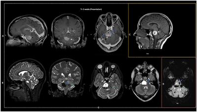 Case report: Delayed outflow obstruction of a DVA: A rare complication of brainstem cavernoma surgery